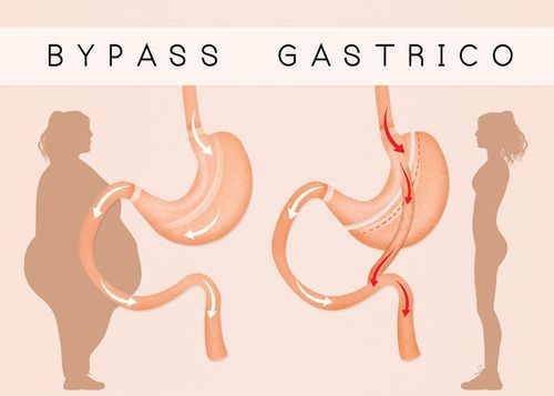 bypass gástrico esquema de intervención